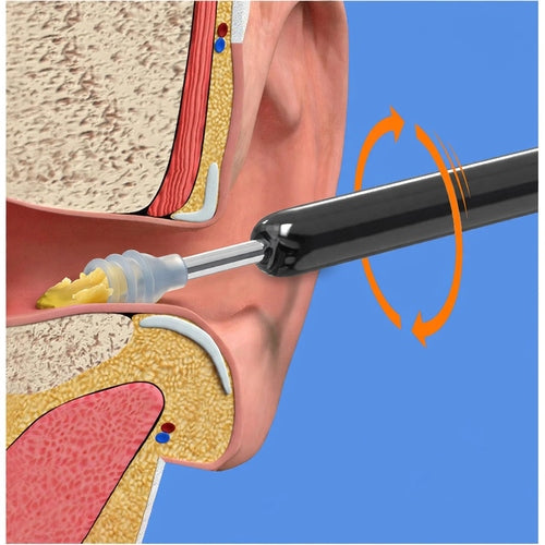 Earwax Removal Kit